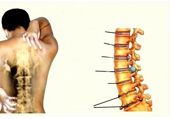 Phase der zervikalen Osteochondose