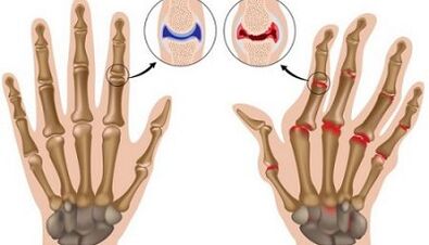 Die Hauptunterschiede bei Arthritis und Arthrose