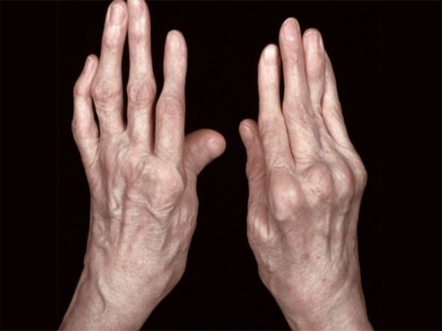 Arthritis als Ursache für Schmerzen in den Fingern Gelenke