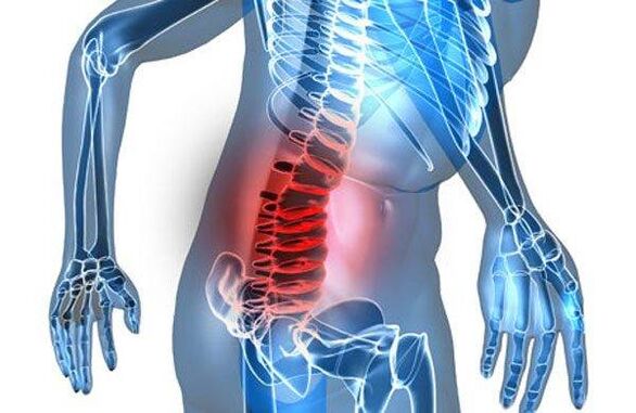 Wirbelsäulendeformität im vierten Stadium der lumbalen Osteochondrose