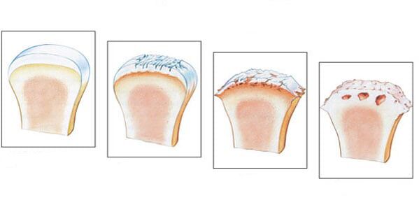 Gesundes Gelenk und 3 Grad der Arthroseentwicklung