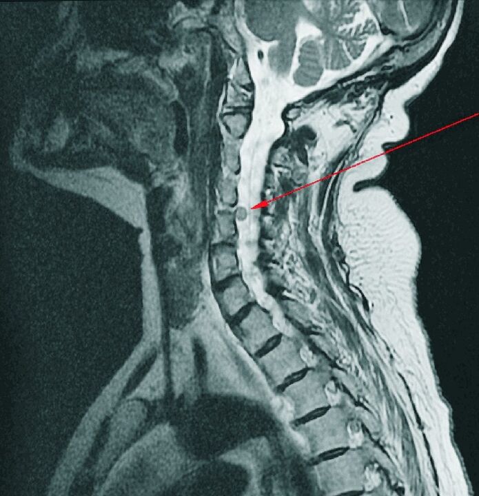 Zwischenwirbelhernie der Halswirbelsäule im Magnetresonanztomographen